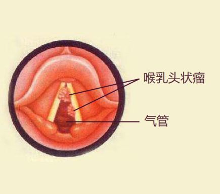 這個病是喉部的良性腫瘤,但會不停地生長,嚴重時形成喉梗阻,危及生命