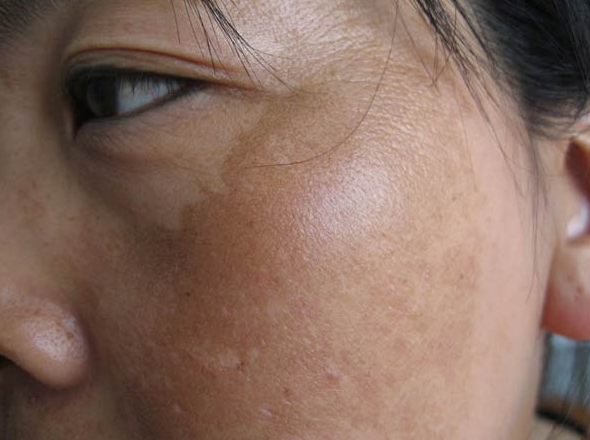 皮肤科医生提醒:黄褐斑影响美观,4种食物易"毁容",不宜多吃_腾讯新闻