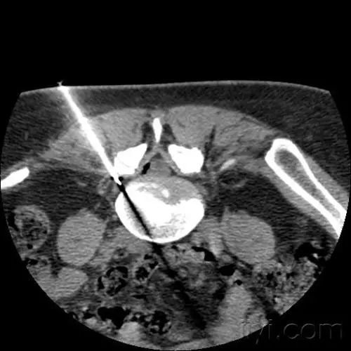 腰椎管狭窄症|腰椎管狭窄症