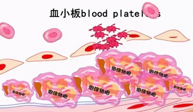 血小板减少症也有轻重之分看看你属于哪个阶段