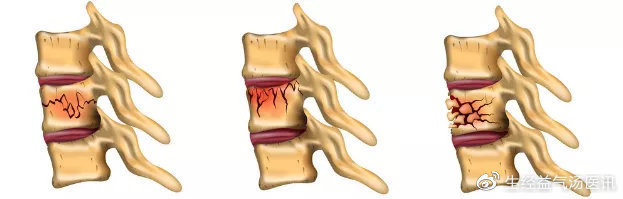 另外, 腰椎的這種 爆裂性的骨折還容易向後突出,對 脊髓或者是 馬尾