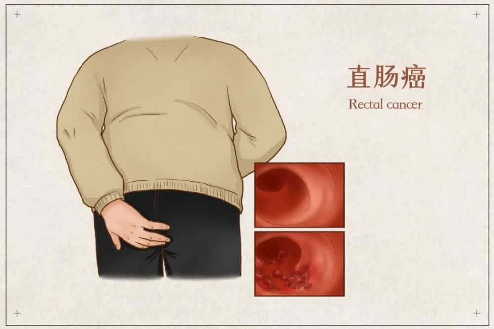 偶尔便血 怎么就得了癌 医生提醒 这些人宜早做肠镜 腾讯新闻
