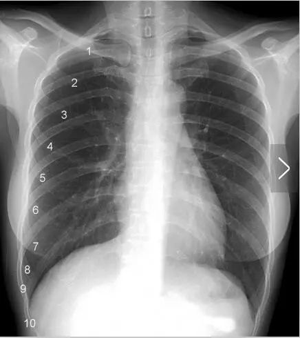 影像解剖入门 正常胸片怎么看 Qtc Care