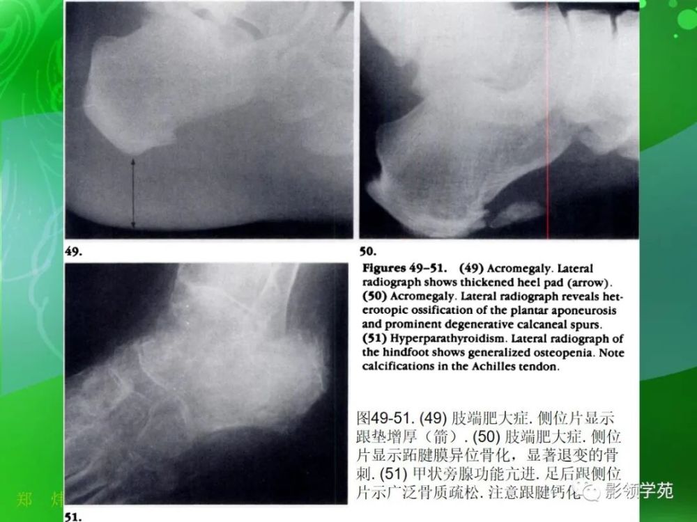 跟骨正常与变异影像学表现