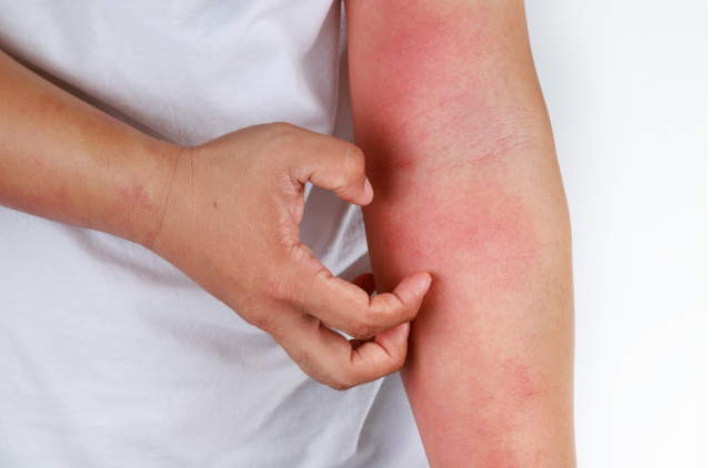 冬天皮肤痒,教你 5 招搞定!