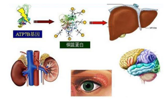 体检报告单中"转氨酶"偏高,意味着什么?医生这样解答