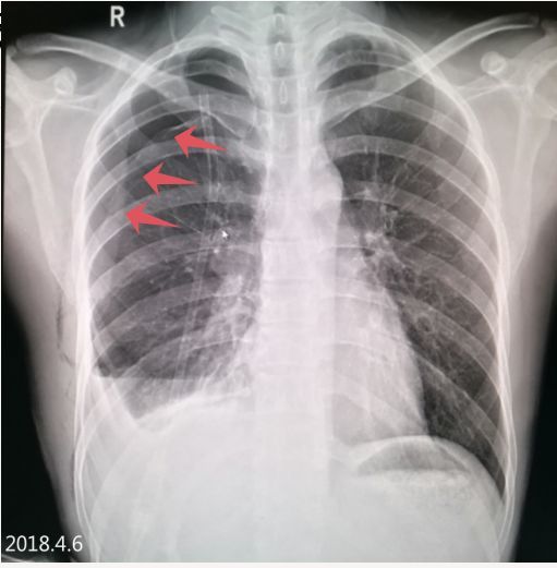 气胸的x线表现6个病例帮你搞定