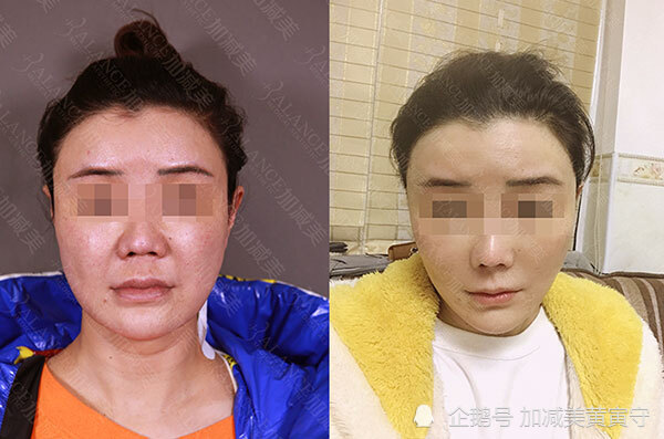 拉皮手术失败原因有哪些面部松垂怎么办加减美整形怎么样