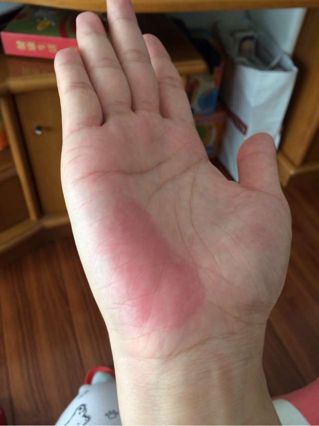 但是如果肠胃不适或是胃炎,在正常情况下手掌也会发红,并且这个症状会