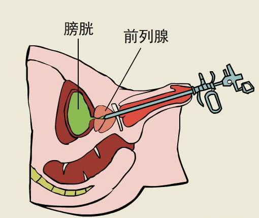 别忍了小便不畅忍了10年活生生拖成癌手术拆除十年定时炸弹