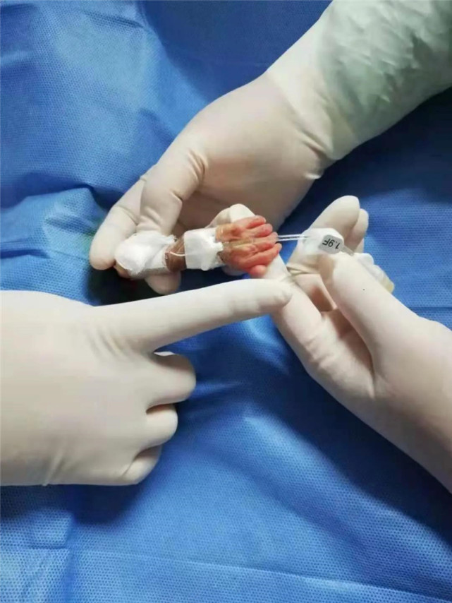 750克早产女婴患了重病好在抢救及时