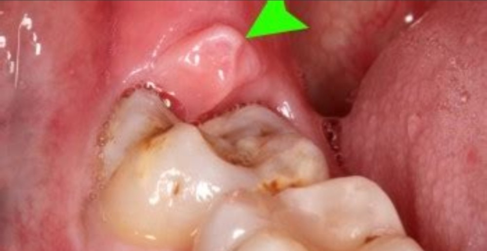 智齿旁边的牙龈一直发炎,要不要把智齿拔掉呢?口腔医生和你说说