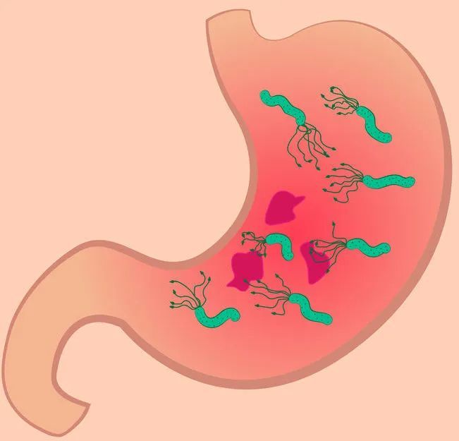 一半中國人感染幽門螺桿菌不根治易遭胃癌華西專家這些情況還真不用治