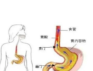 了解食管狭窄的三处位置采取合适的治疗方法更好应对食管狭窄