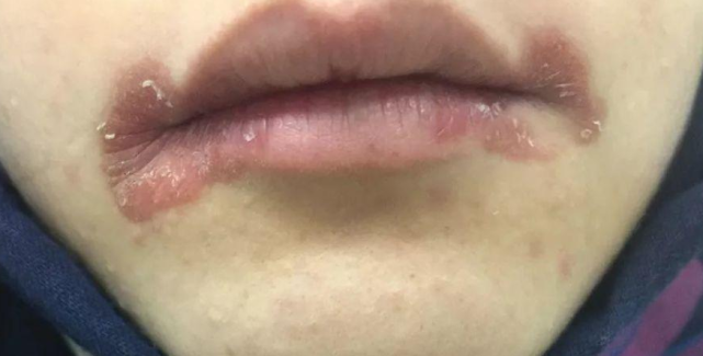 嘴角烂是因为上火这可不一定嘴角烂可能是这原因导致的