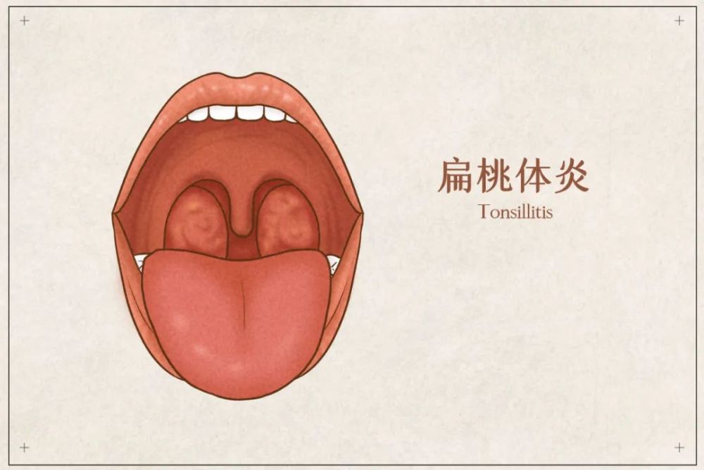 我們常說的扁桃體發炎,一般是顎扁桃體發炎,它位於口咽兩側的三角形