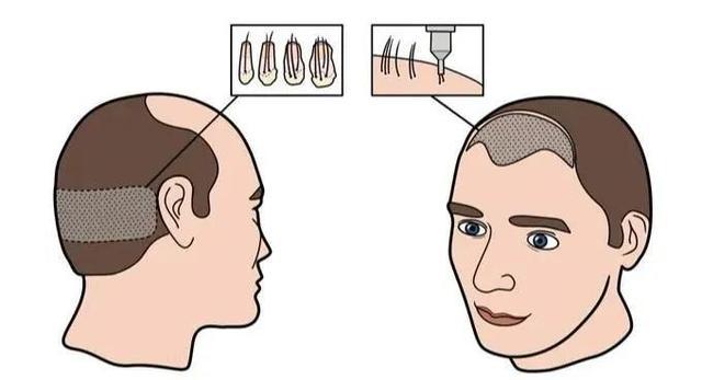 植发后还会脱发吗