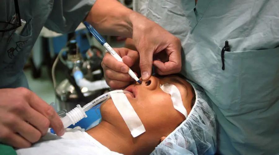 镇静镇痛下经鼻气管插管技术