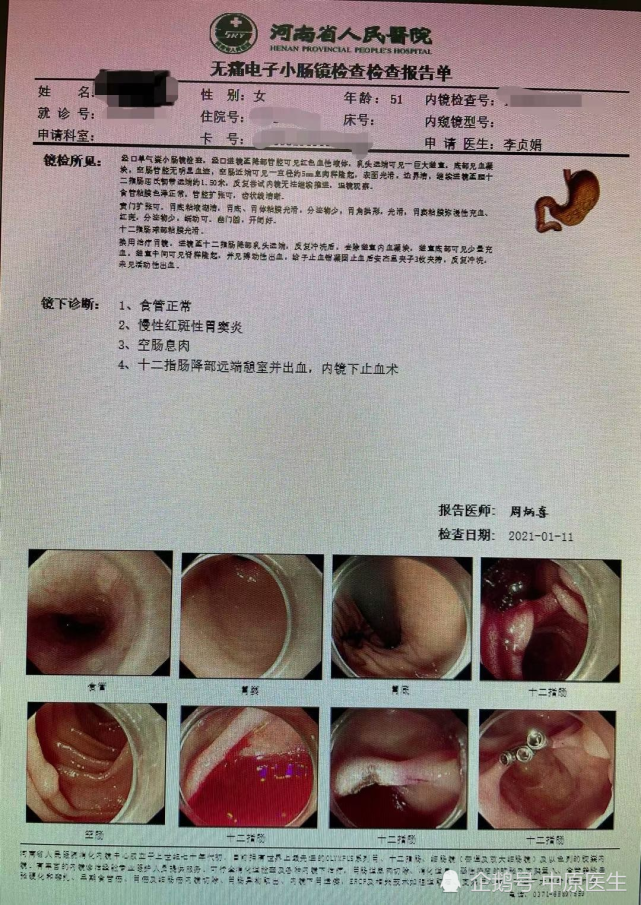 50岁女子十几年反复消化道出血,被细心专家查出原因