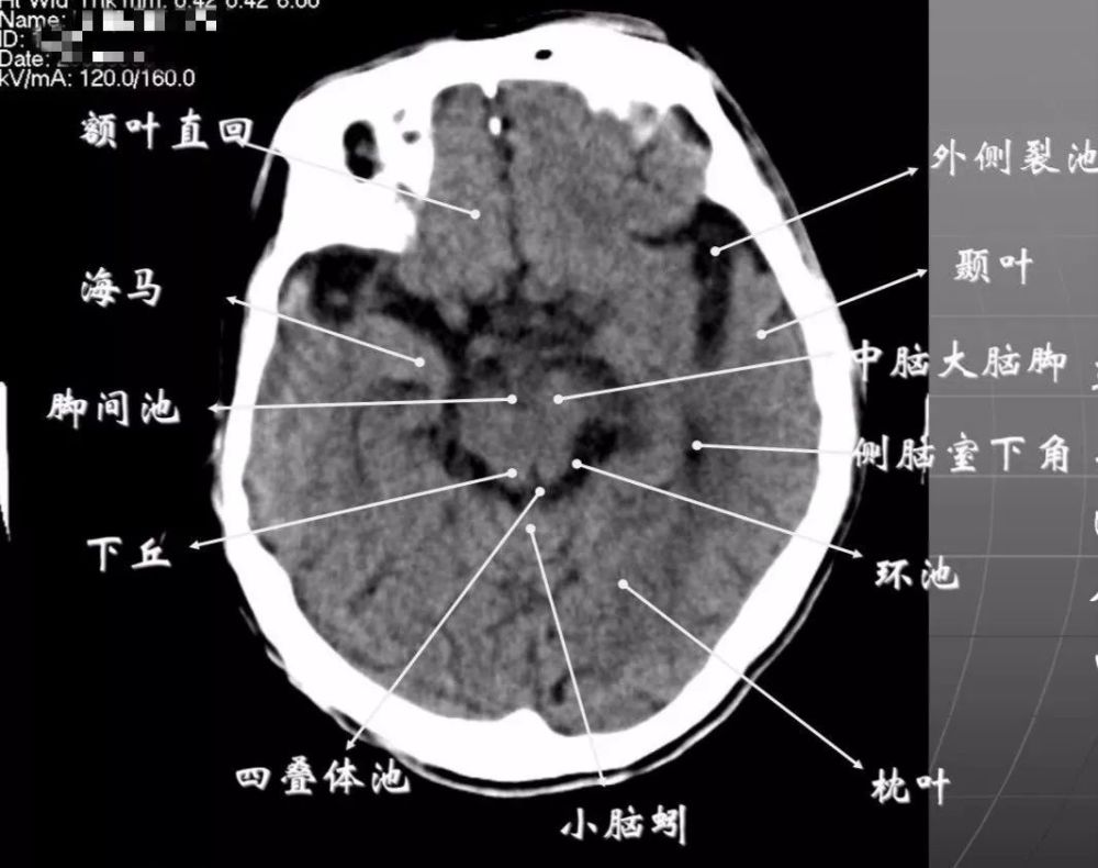 颅脑ct怎么看正常和异常影像分别是什么