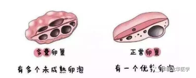 但均存在對卵巢的過度刺激及術後卵巢周圍組織出現粘連甚至造成卵巢廢