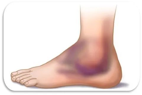 崴脚后怎么处理 运动医学专家这么说 腾讯新闻