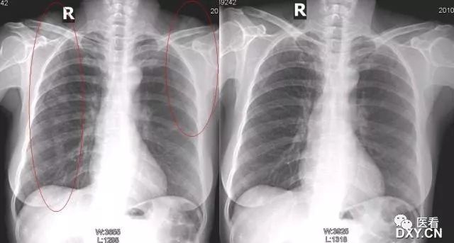 6例胸片假象分析,作為影像醫生,總結一點經驗教訓!