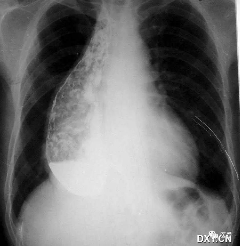 6例胸片假象分析作為影像醫生總結一點經驗教訓