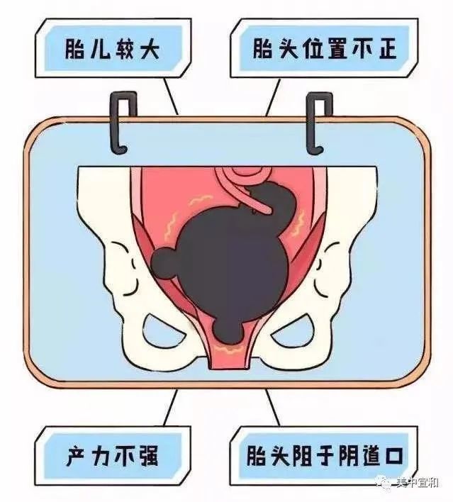侧切或撕裂,真的是顺产的"标配"吗?