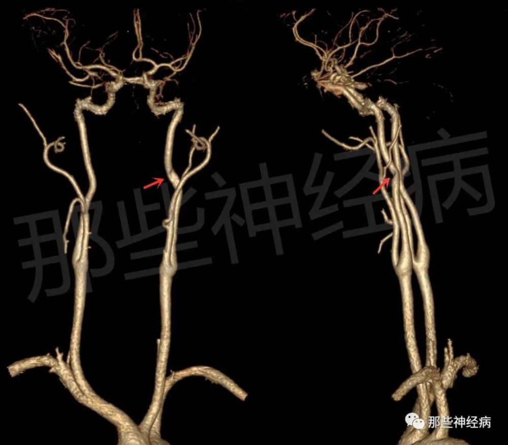 头颈部cta重建:左侧颈内动脉c1段局限性轻度狭窄!