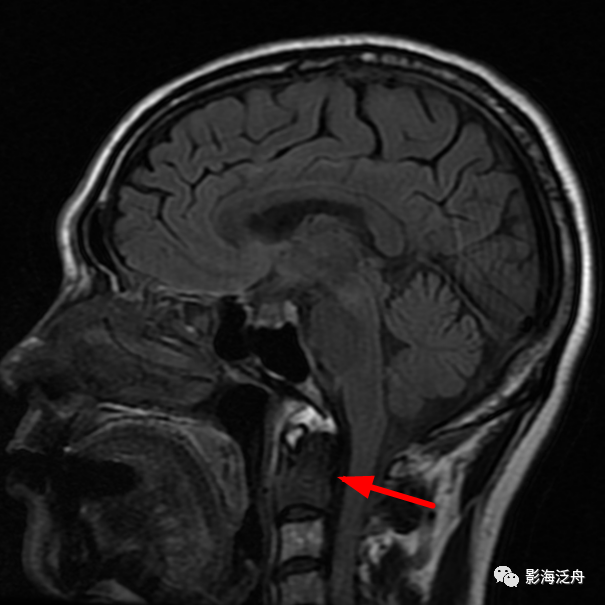 【必讀】這些顱腦mr容易漏診,都總結好了!