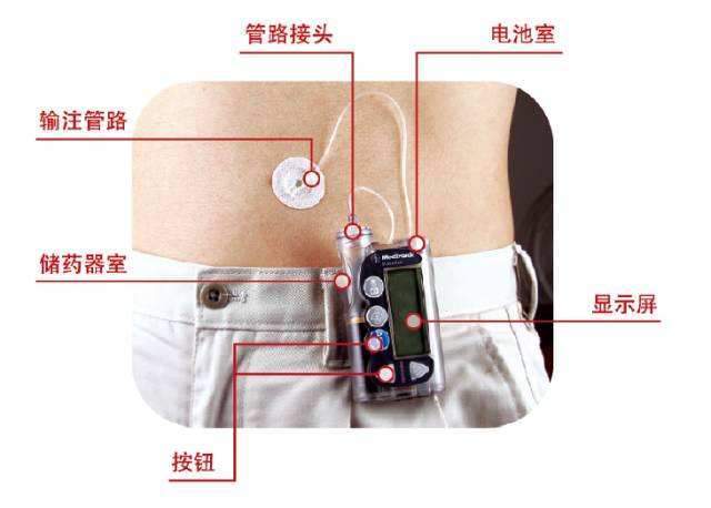 【答疑】买了胰岛素泵不会用,应该如何开启第一步_腾讯新闻