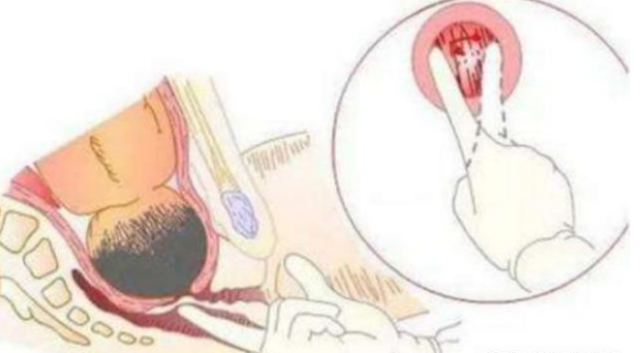 害怕内检?分娩前的内检原来是这么回事,看完你还害怕吗