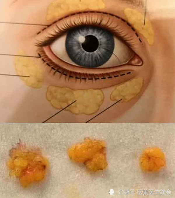 老路曾不止一次给大家科普过,我们的眼袋脂肪是由内,中,外三小团构成