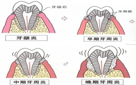 牙潔石的