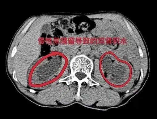 葉華醫生立即為其查泌尿系ct,結果提示:雙腎積水,前列腺增生,膀胱結石