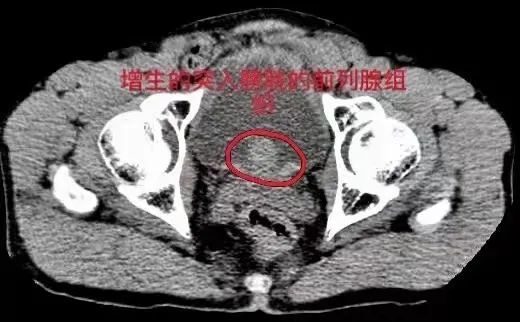 叶华医生立即为其查泌尿系ct,结果提示:双肾积水,前列腺增生,膀胱结石