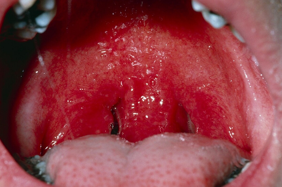 咽炎难治愈?咽喉科:一个小方子,和干痒咳说"分手"!