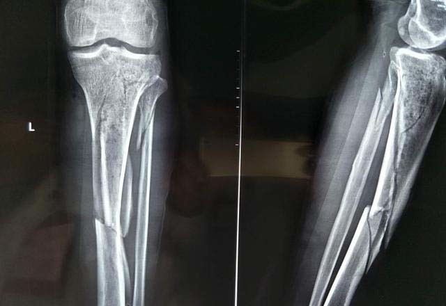 胫骨骨折做了内固定手术后 有什么办法能正常走路吗 腾讯新闻