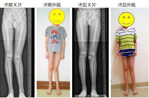 x型腿需要矯正或者干預嗎?什麼是膝外翻?_騰訊新聞