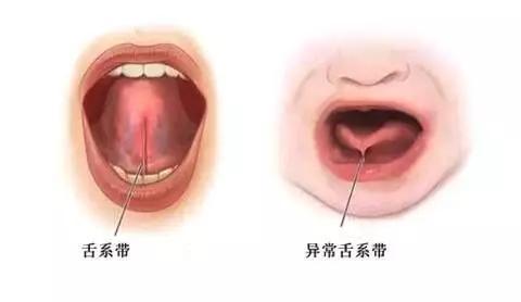 主要表现为宝宝舌头外伸时受限,而且伸舌时会因被牵拉而出现一个凹陷