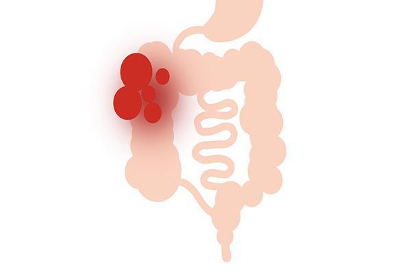 肠道|屁是怎么来的？憋着的屁都去哪里了？对身体的健康有影响吗？