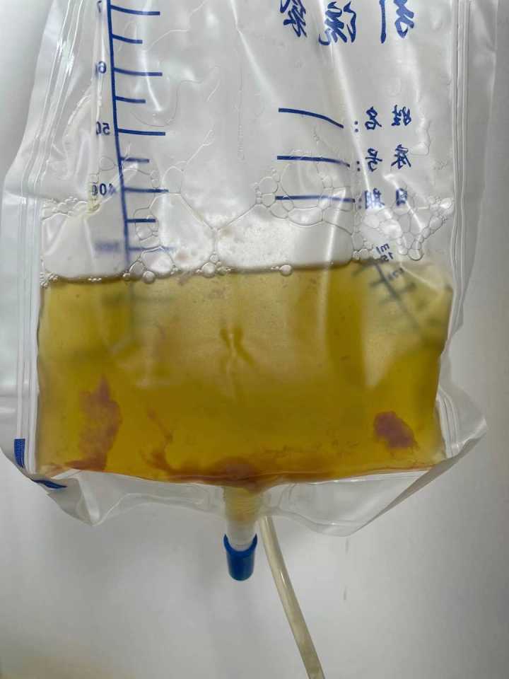 6岁孩子左肺被"淹没"一半,满是黄色脓液!医生说:这种情况要当心