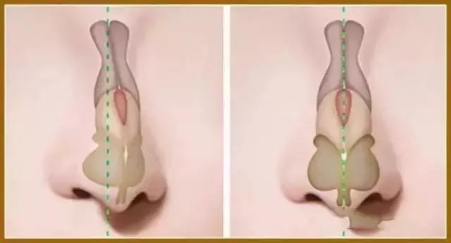 假体位移,松动主要发生在使用硅胶假体时,由于将假体植入到鼻背筋膜下