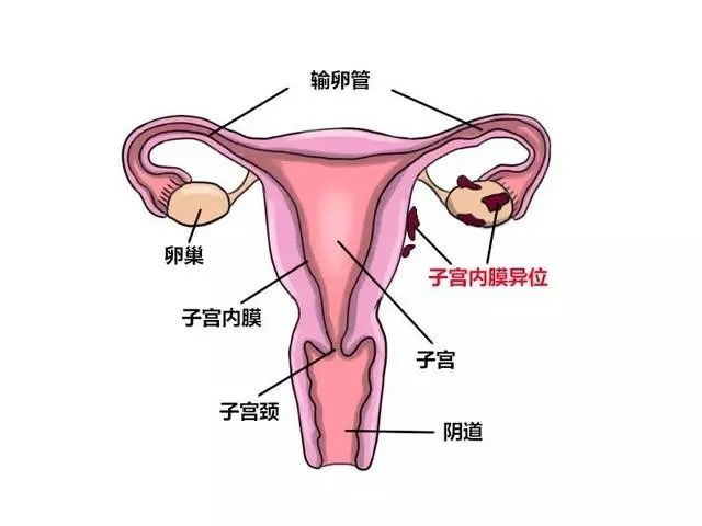临床上,很多痛经女性就被诊断为 子宫内膜异位症(简称内异症),有的