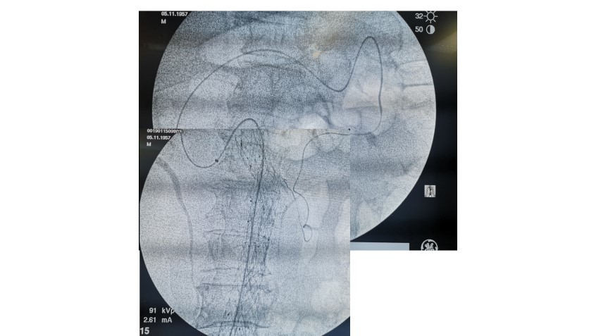 这家医院攻克腹主动脉瘤手术内漏难题完成全国首例Ⅱ型内漏根治术
