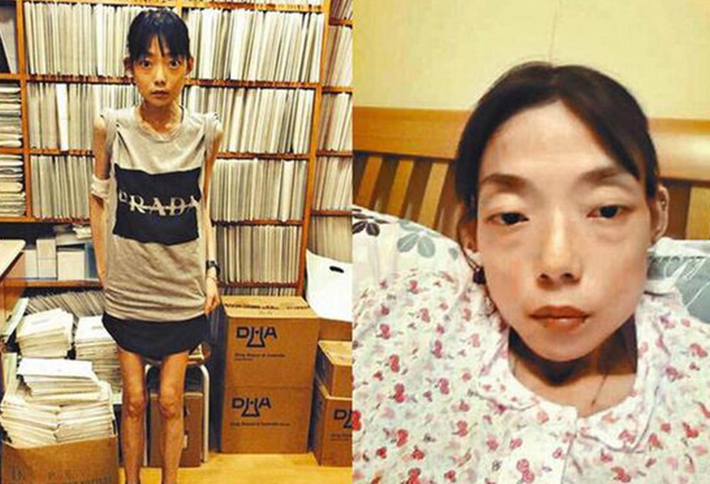 放弃牛津大学嫁入豪门,8年后瘦到44斤,如今瘫痪丈夫另娶