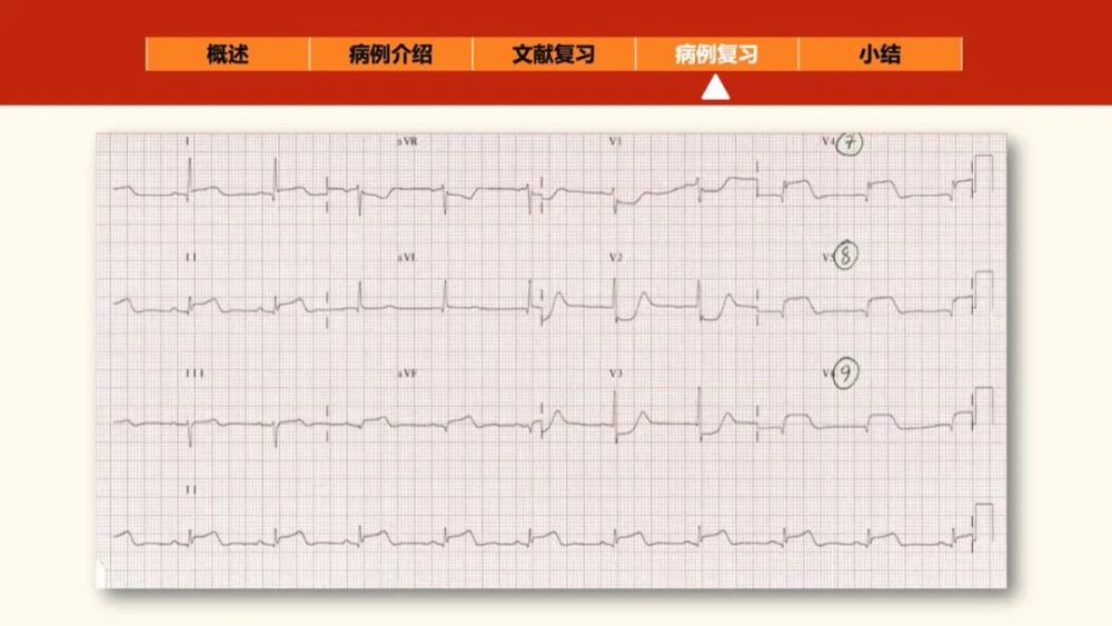 "正后壁"心肌梗死的心电图线索_腾讯新闻