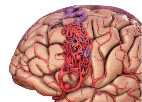 血管|畸形|脑出血|癫痫|脑血管畸形