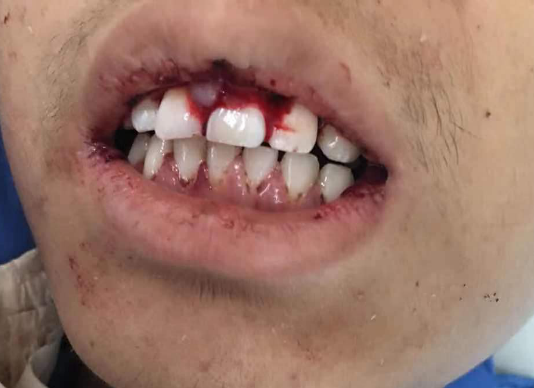 维甲酸evi1阳性急性髓系白血病患者的福音